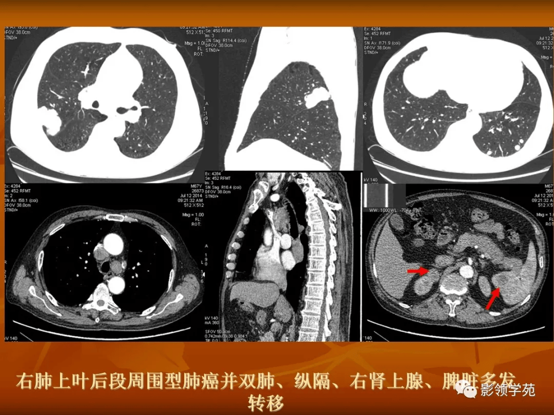 是診斷肺部疾病的基礎,要仔細觀察ct片上所呈現的各種表現,發現其特點