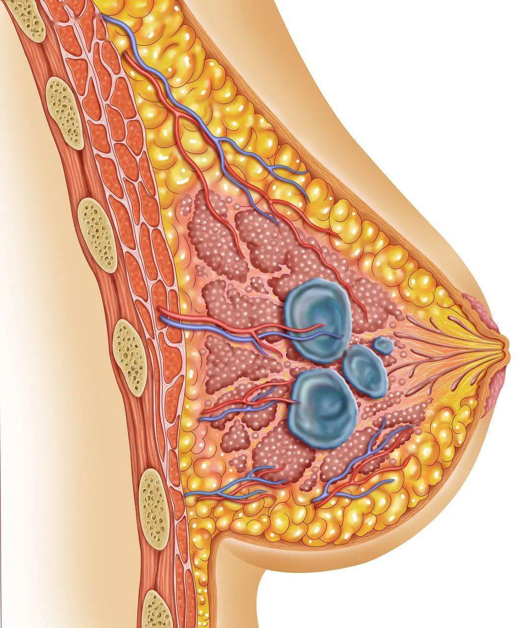 乳房小结节图片