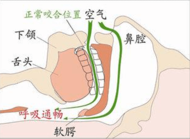 年轻男子吃三种降压药依然降压失败,白天嗜睡险些酿成车祸!