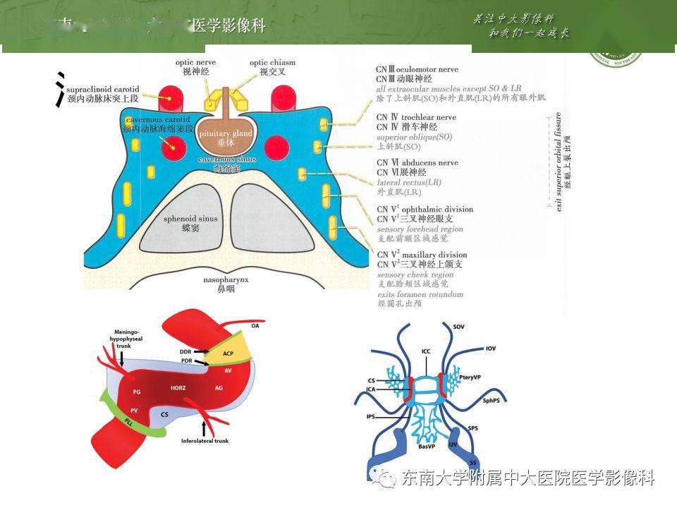 海绵窦区常见肿瘤垂体瘤三叉神经鞘瘤