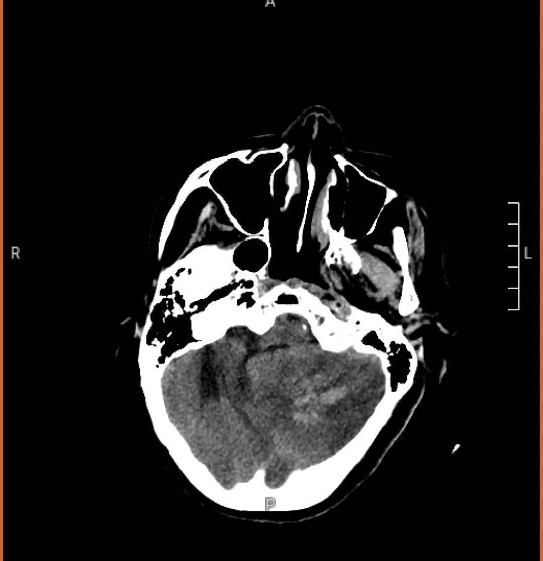 颅脑核磁共振科室值班医生尹洪涛结合患者临床表现及大面积小脑梗死