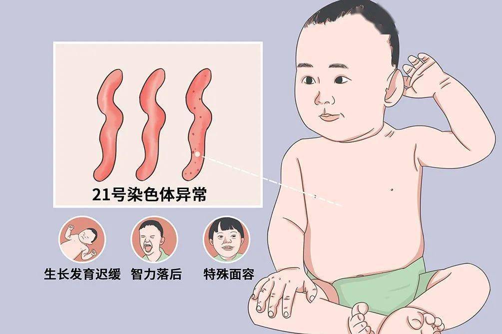 唐氏综合征又称21-三体综合征,是由于21号染色体异常增多导致的最常见