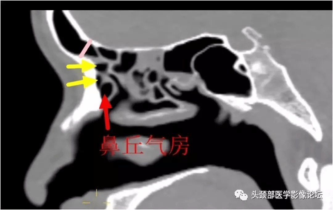 钩突位置图片