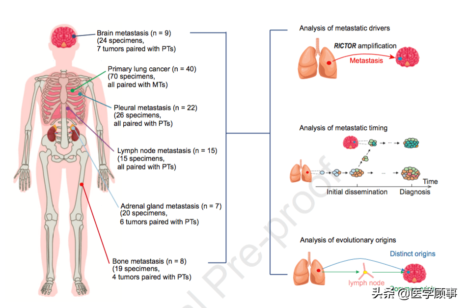 最新研究揭示肺癌转移机制肺癌转移时间比临床发现早27年