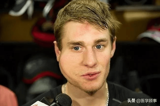 警惕男孩小时候得过腮腺炎成年后有可能无法生育