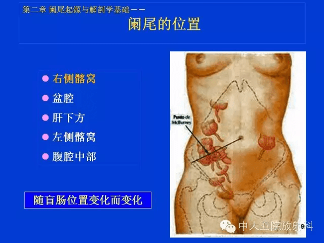 阑尾炎症状超全解析 a958d15859a648e69204c7d613196813.png