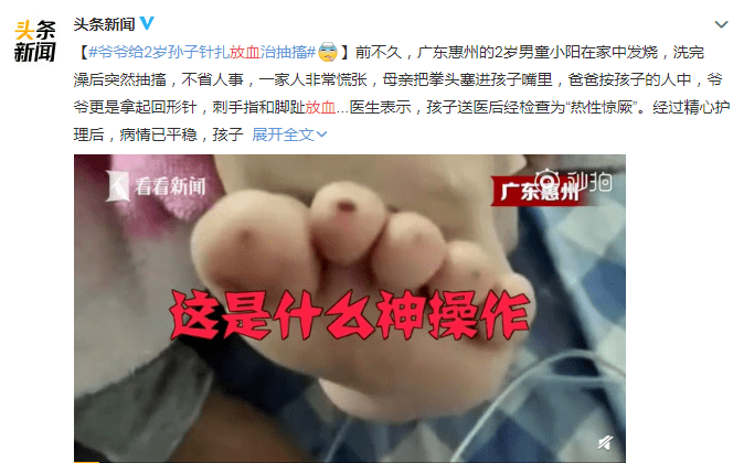 而爷爷更是拿起回形针,刺孩子的手指和脚趾放血~爸爸按住孩子的人中