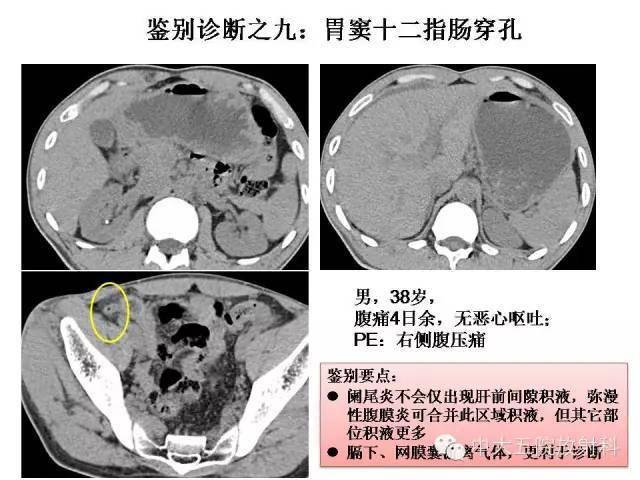 阑尾炎ct怎么看图解图片