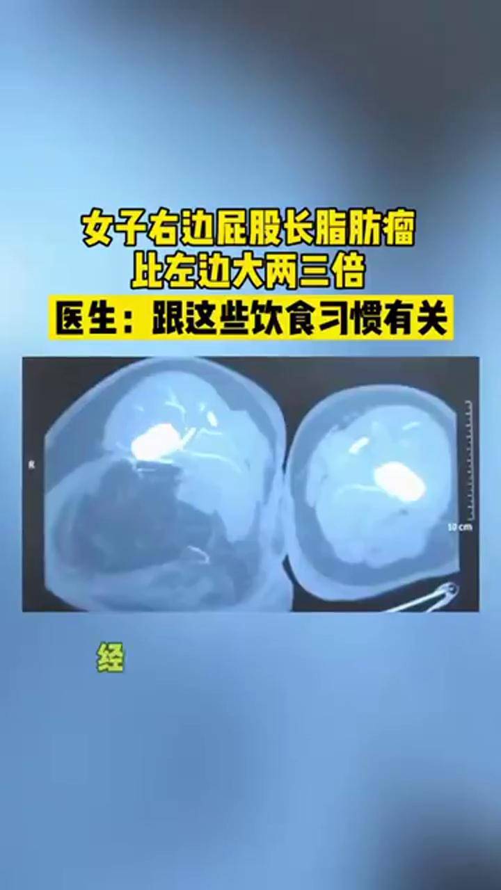 女子右邊屁股長脂肪瘤比左邊大兩三倍醫生跟這些飲食習慣有關