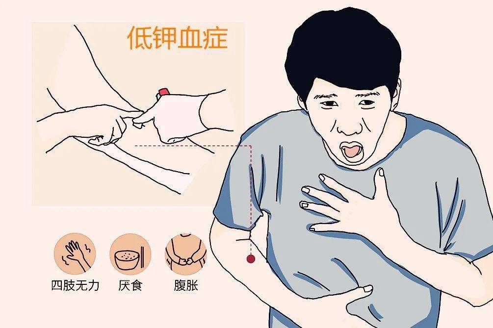 花季少年一运动就四肢无力,原来是低钾血症在作妖