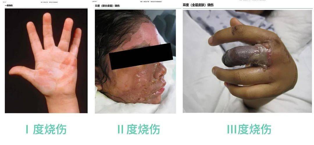 孩子燙傷奶奶一個動作全家反對醫生卻點贊