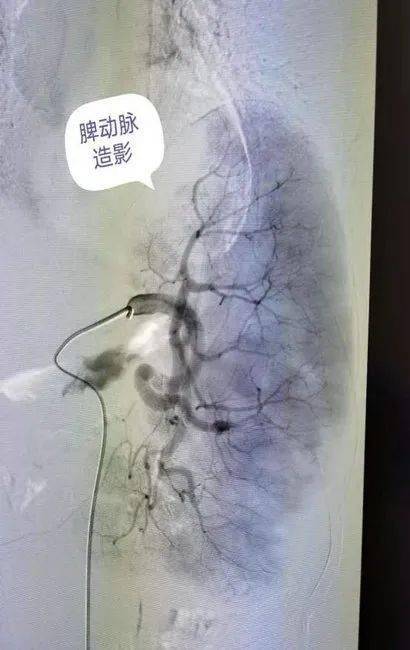 脾动脉栓塞术图片