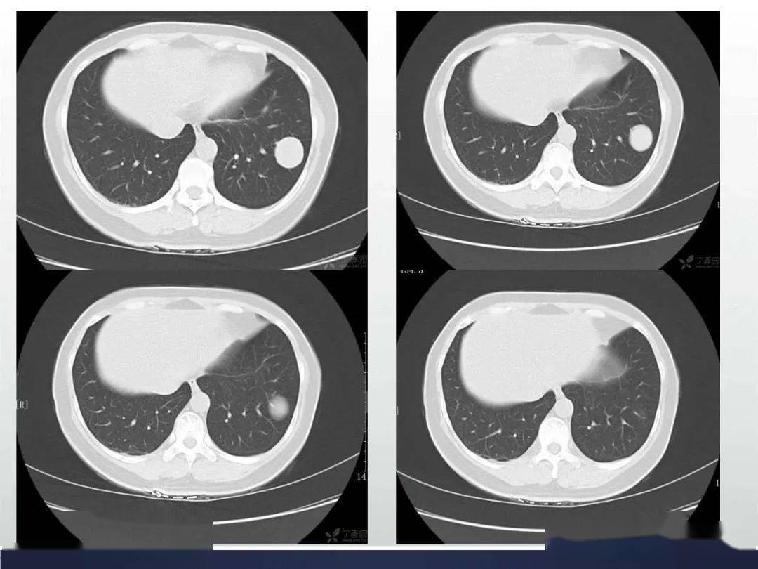 丁香园版主ct高少老师十论灶肺交界面截然征象的鉴别诊断之二