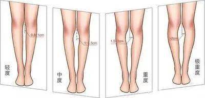如果膝盖间隙小于3cm的话,可以判断为轻度o型腿,如果大于3cm的话,就是
