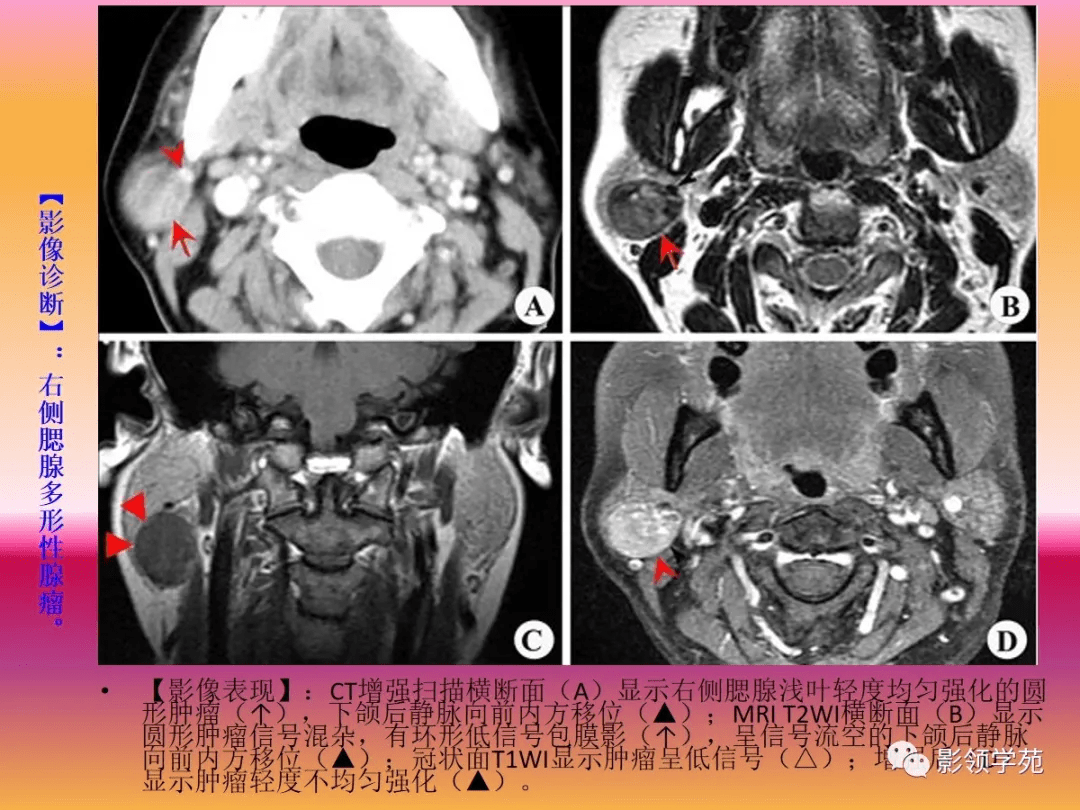 腮腺疾病的ct诊断与鉴别诊断
