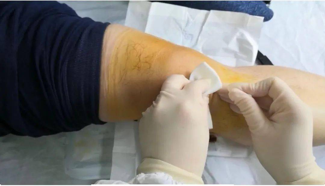 "李丽秋说,小针刀属于微创治疗,一般骨关节炎患者需要进行3至5周的