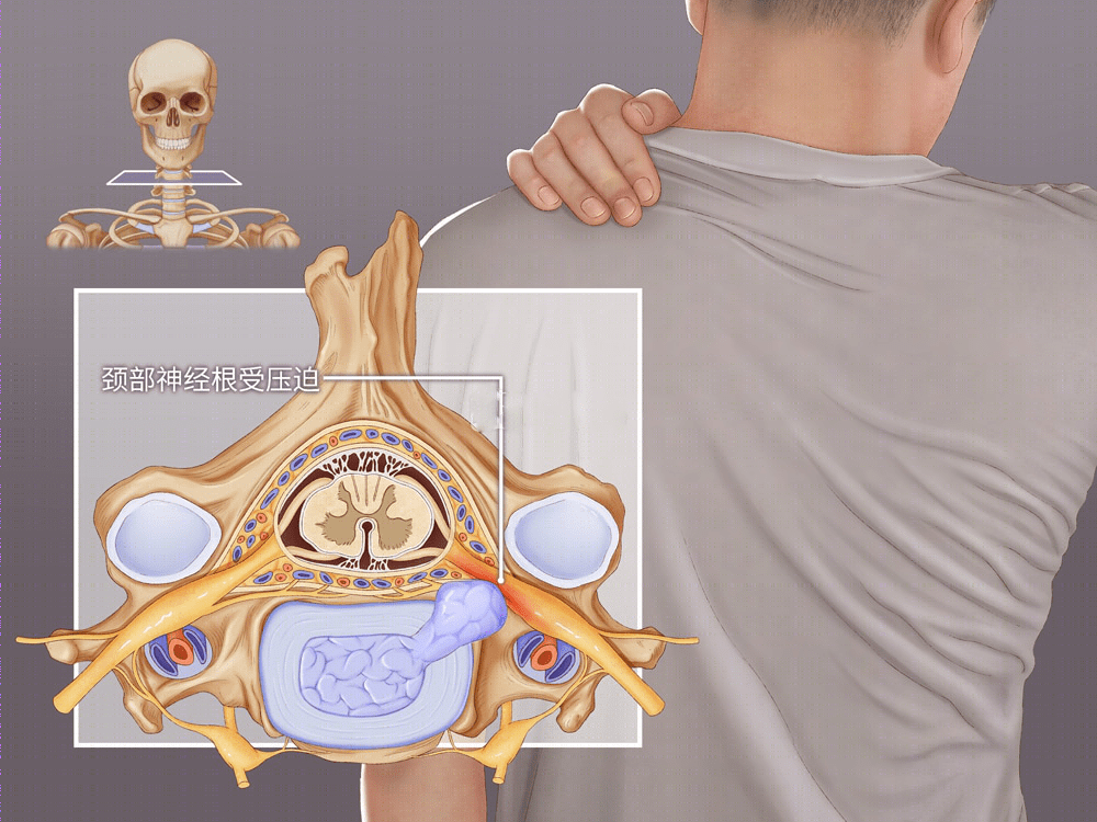 頸肩部疼痛手臂麻木可能是頸椎病
