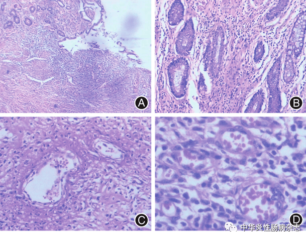 病案撷英丨肠型白塞病伴肠穿孔一例