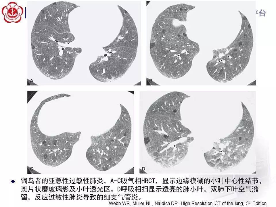 过敏性肺炎ct图片图片