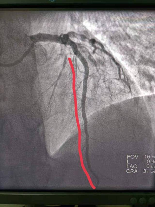 44岁男子凌晨2点心肌梗死科普为什么年轻人心脏病越来越多