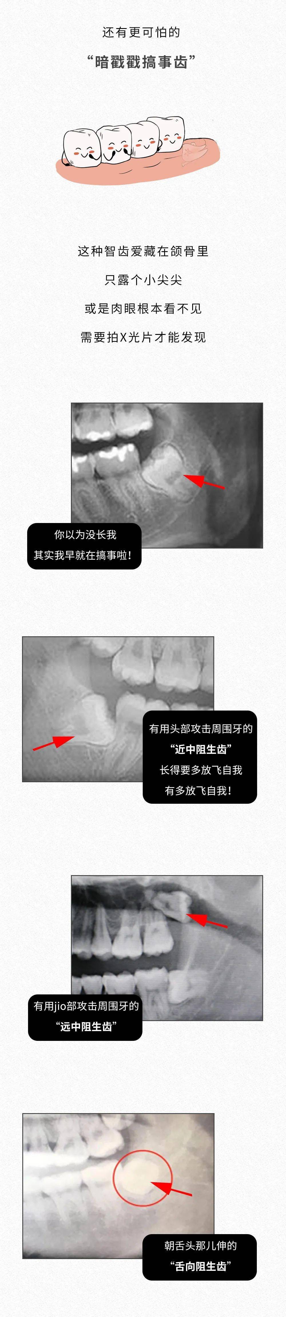 拔智齿全过程图片