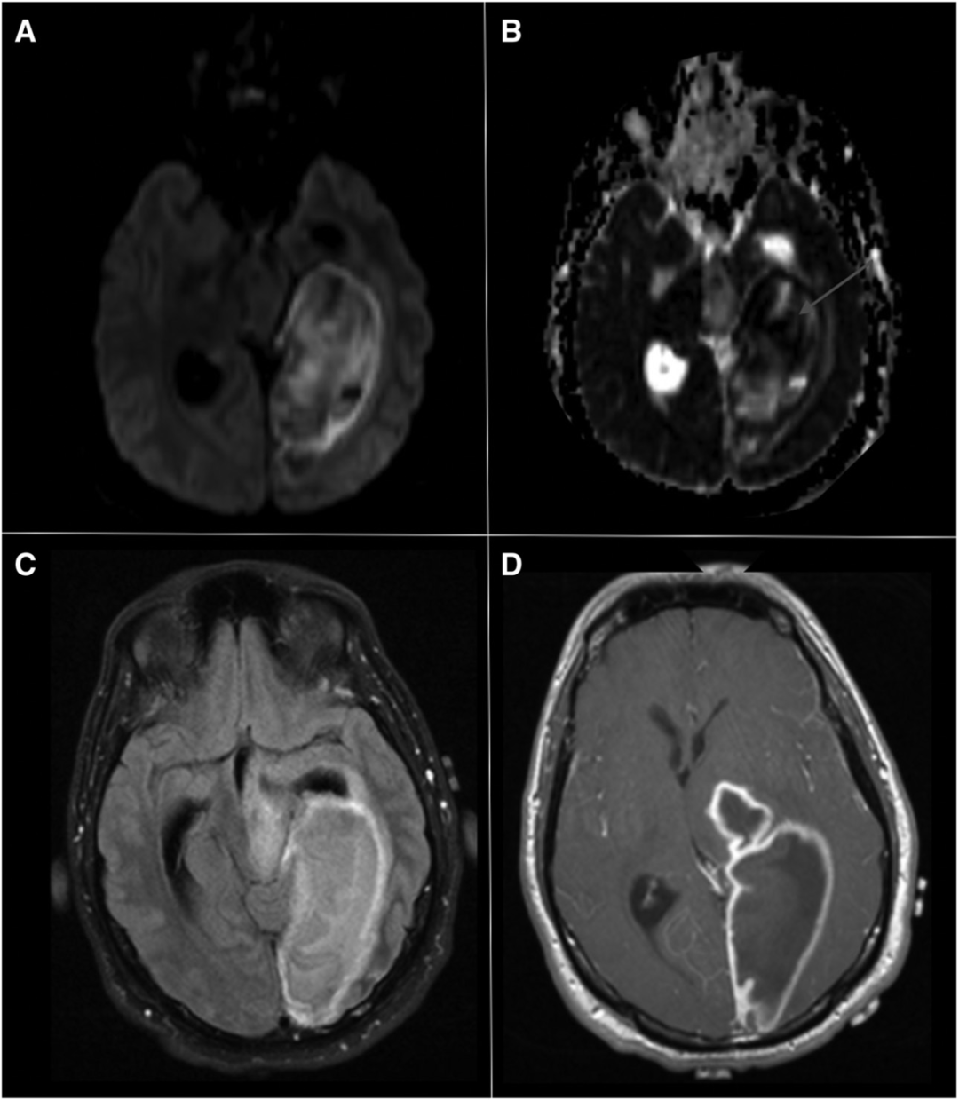 Stroke：脑梗死后迟发性脑脓肿1例_丘脑