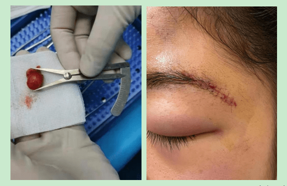 23岁女护士眼睛不痛不痒,竟查出眼眶肿瘤!