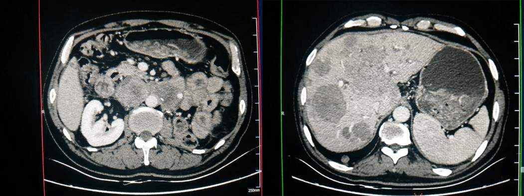 左侧肾癌术后,腹膜后淋巴结及肝脏多发转移瘤