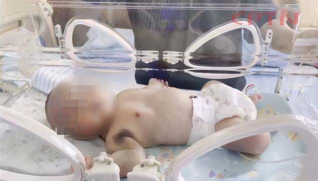 新生男婴患罕见怪病玻璃人满身淤青一碰就出血