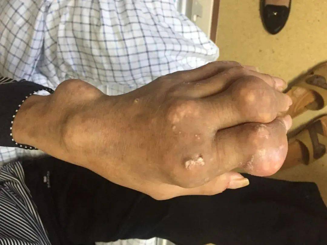 吓人小伙手脚密密麻麻长满石头医生叹息这习惯很多人都有