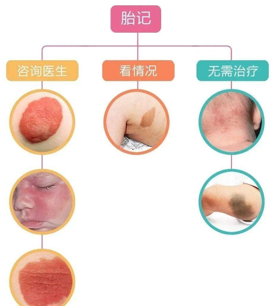 6种宝宝常见胎记大起底这3种赶紧去看医生附图