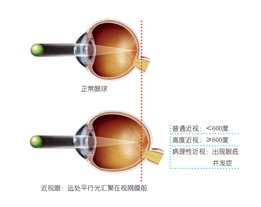 北京同仁眼科医院眼科治疗黄斑变性_北京同仁眼科黄斑病变专家_北京同仁医院眼科黄斑变性专家