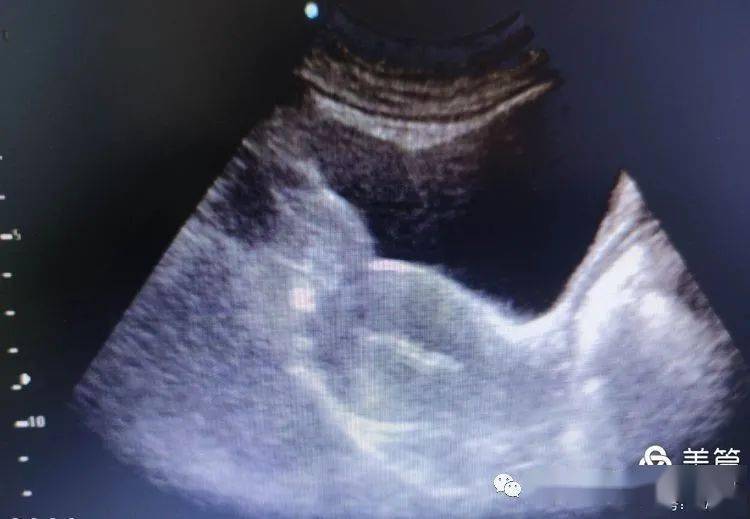 宫内节育器位置的超声检查