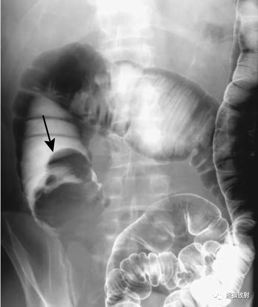 肠套叠x线表现图片
