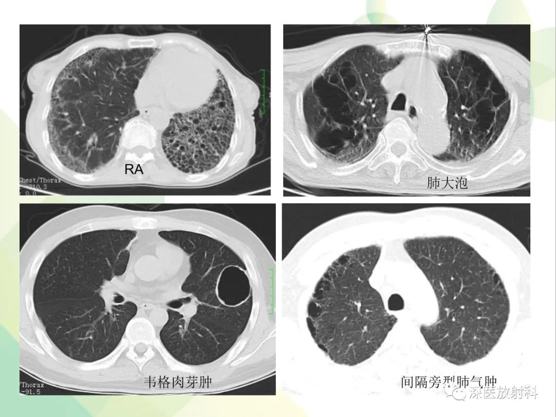 肺弥漫性磨玻璃密度病变的ct诊断