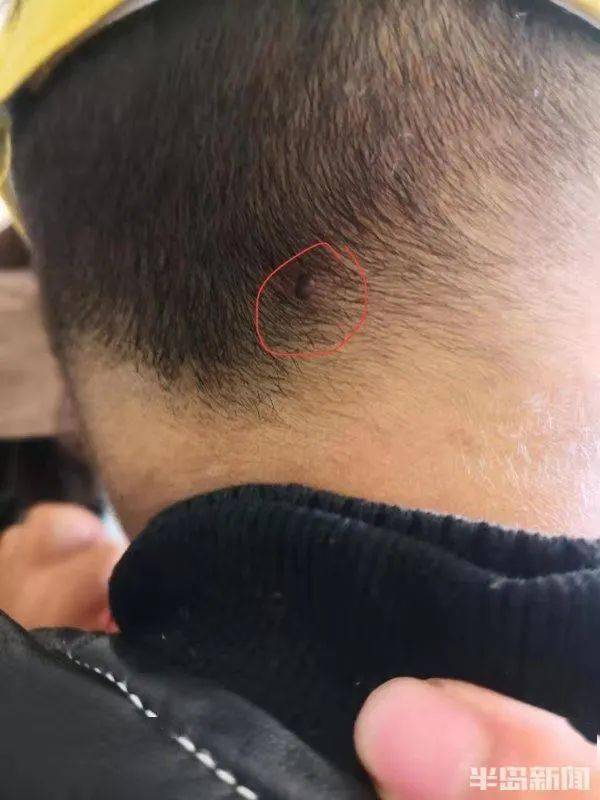 3岁男童后脑勺疼,结果发现一个"黑点"!严重可致命.