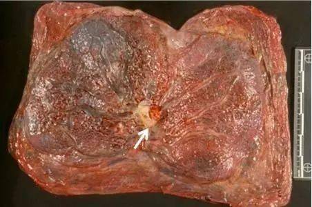 分析几种异常形态的胎盘