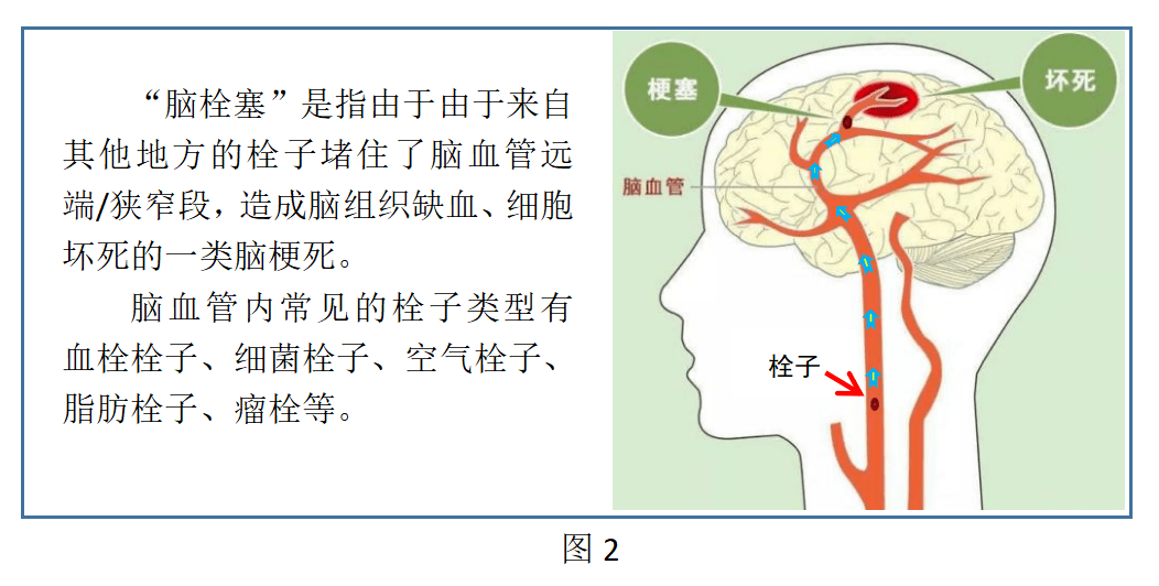 科普丨脑卒中脑中风脑梗死脑梗塞脑血栓脑栓塞脑出血脑溢血傻傻分不