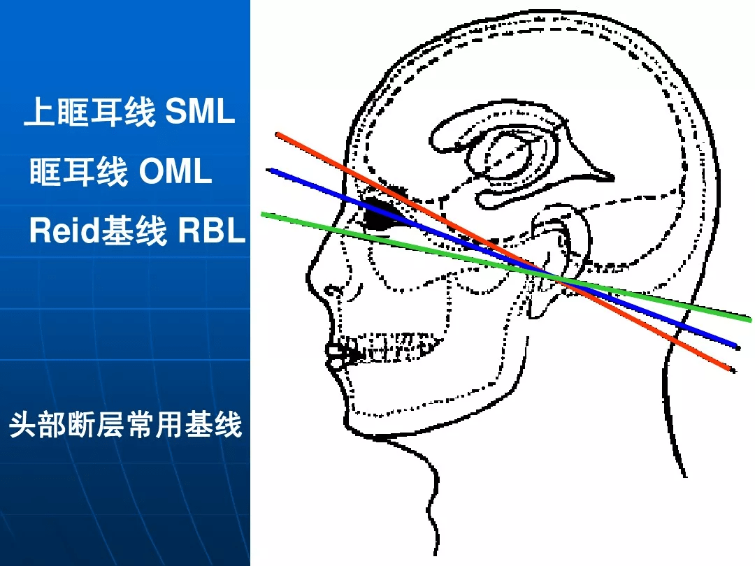 ct头颅扫描定位线图片图片