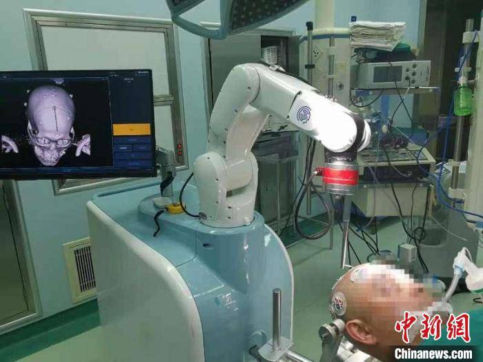 上海|上海专家成功使用3D结构光手术机器人治疗脑出血 简便、高效、精准