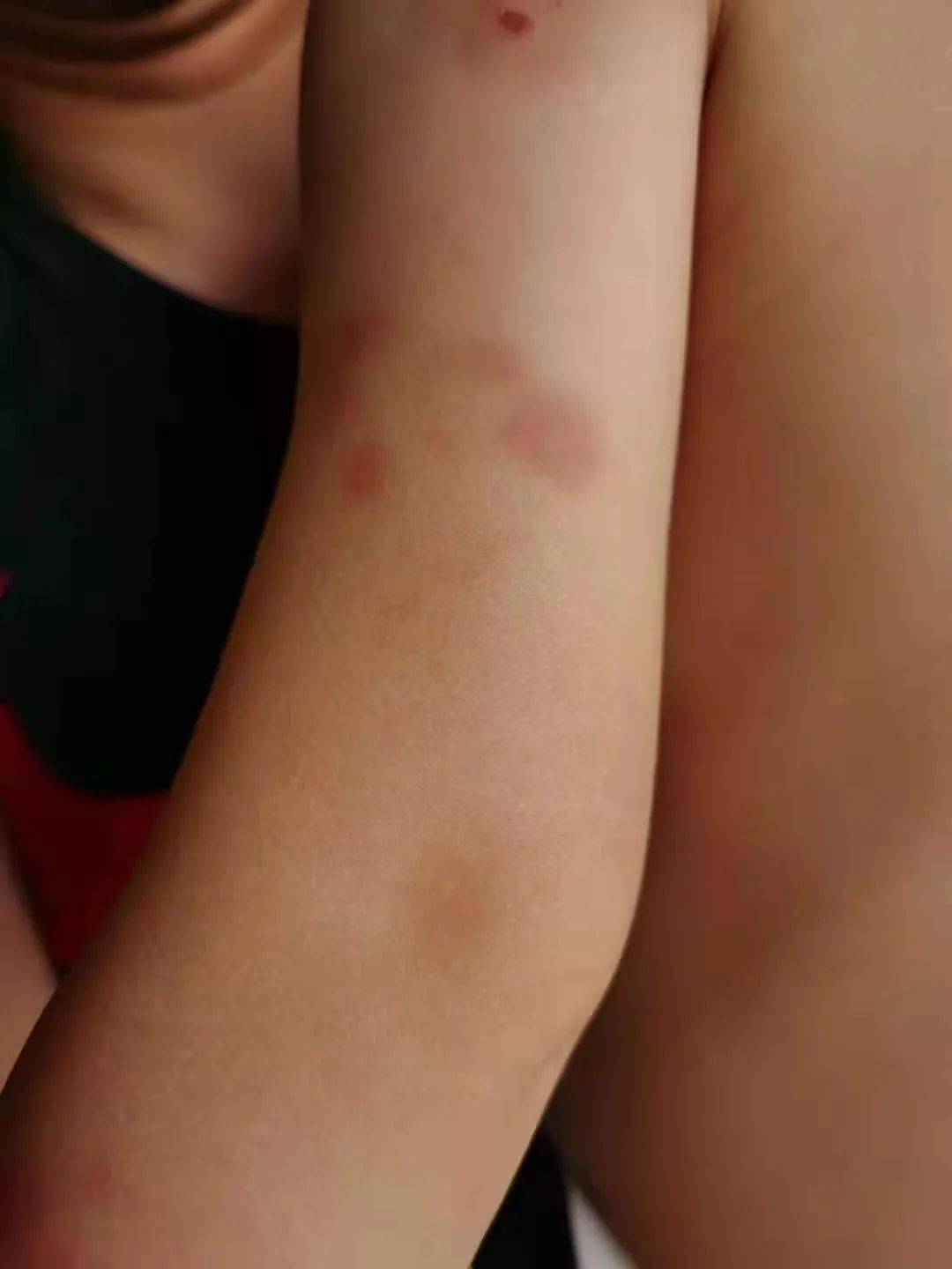 南宁3岁男童身上出现多处伤痕幼儿园没有打孩子监控没有开