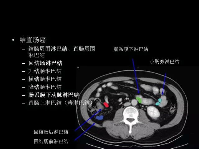 髂血管 淋巴结图片