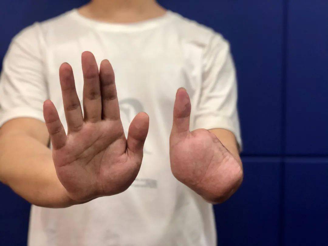 21岁小伙被剁断4根手指!哭诉缅北噩梦