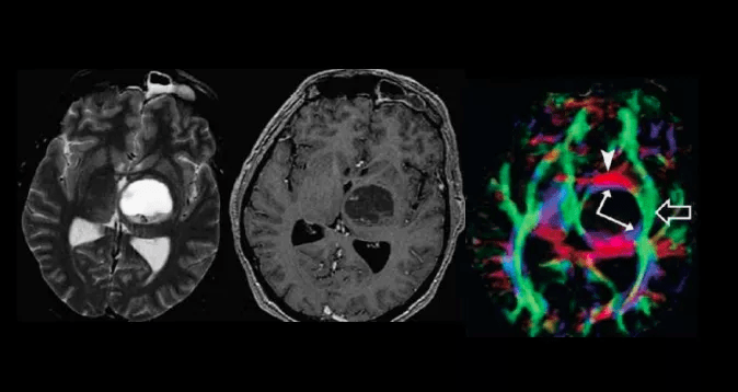 磁共振功能成像dti2