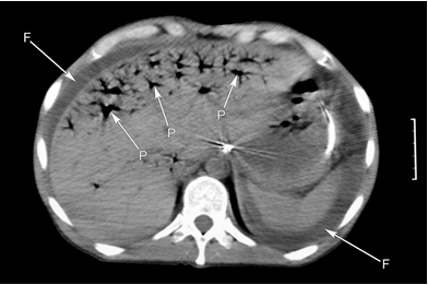 85歲女性的腹部ct:肝門靜脈系統內可見氣體(p),肝脾周圍積液(f),胃內