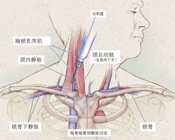 颈外静脉穿刺部位图片