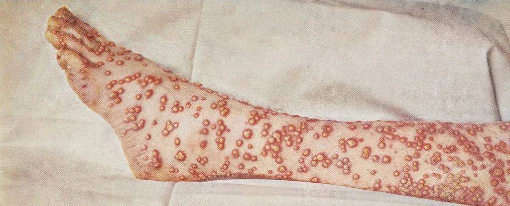 水痘是由于其痘的形态与天花的痘相类似,以至于在多个世纪以来都