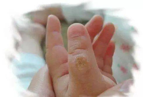 吮吸手指还可能让宝宝吃掉手指上的细菌;被吸吮的手指也有可能出现