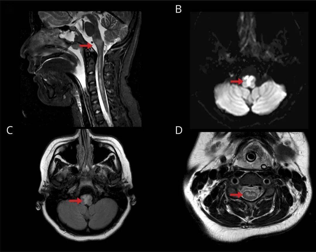 图像:脊髓前动脉闭塞引起的双侧延髓内侧梗死的神经影像学检查(a)mri