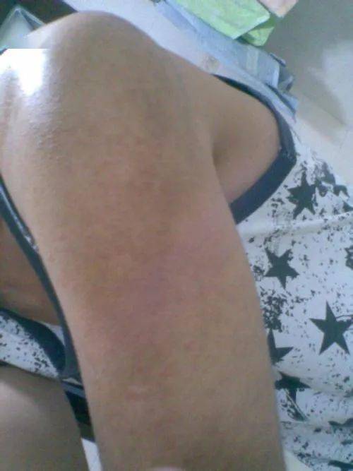 鸡皮肤和牛皮癣的区别的简单介绍 鸡皮肤和牛皮癣的区别的简单介绍